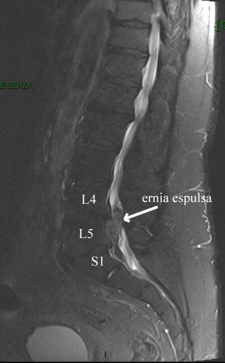 Ozonoterapia ecoguidata Milano e Parabiago comoda con la Svizzera dettaglio ernia espulsa colonna vertebrale Ozonoterapia ecoguidata Milano e Parabiago comoda con la Svizzera dettaglio ernia espulsa colonna vertebrale