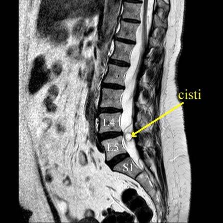 Ozonoterapia ecoguidata Milano e Parabiago comoda con la Svizzera dettaglio cisti vertebrale Ozonoterapia ecoguidata Milano e Parabiago comoda con la Svizzera dettaglio cisti vertebrale