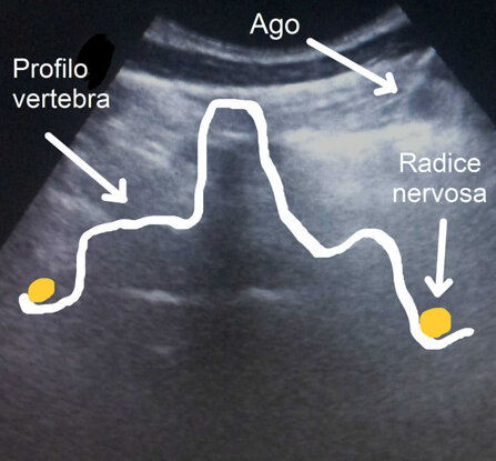 Ozonoterapia ecoguidata Milano e Parabiago comoda con la Svizzera profilo vertebra e radice nervosa