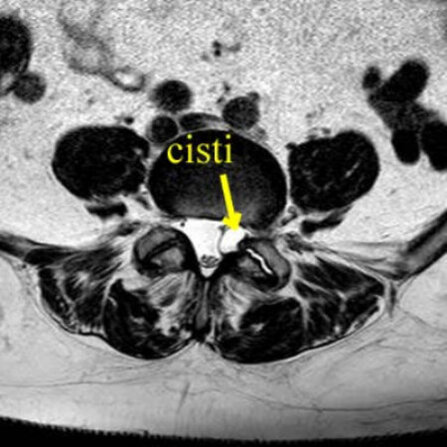 Ozonoterapia ecoguidata Milano e Parabiago comoda con la Svizzera dettaglio cisti lombare 2 Ozonoterapia ecoguidata Milano e Parabiago comoda con la Svizzera dettaglio cisti lombare 2