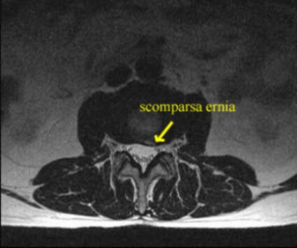 Ozonoterapia ecoguidata Milano e Parabiago comoda con la Svizzera dettaglio scomparsa ernia Ozonoterapia ecoguidata Milano e Parabiago comoda con la Svizzera dettaglio scomparsa ernia