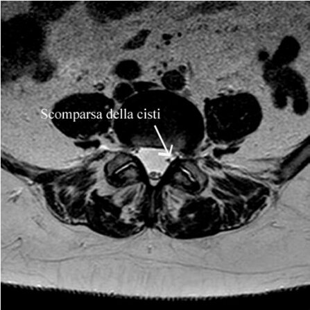 Ozonoterapia ecoguidata Milano e Parabiago comoda con la Svizzera dettaglio scomparsa della cisti lombare Ozonoterapia ecoguidata Milano e Parabiago comoda con la Svizzera dettaglio scomparsa della cisti lombare
