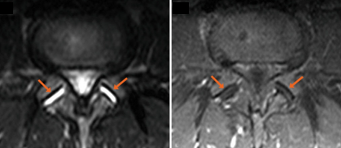 Ozonoterapia ecoguidata Milano Parabiago sindrome faccette lombari articolari evidenza 1 Ozonoterapia ecoguidata Milano Parabiago sindrome faccette lombari articolari evidenza 1