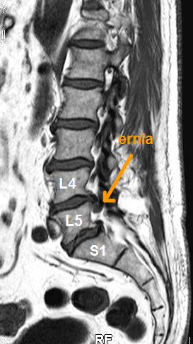 Ozonoterapia ecoguidata Milano e Parabiago comoda con la Svizzera dettaglio ernia vertebrale L5 Ozonoterapia ecoguidata Milano e Parabiago comoda con la Svizzera dettaglio ernia vertebrale L5