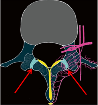 Ozonoterapia ecoguidata Milano Parabiago sindrome faccette lombari articolari scanner 1 Ozonoterapia ecoguidata Milano Parabiago sindrome faccette lombari articolari scanner 1
