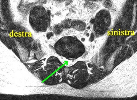Ozonoterapia ecoguidata Milano e Parabiago comoda con la Svizzera dettaglio lombalgia cronica Ozonoterapia ecoguidata Milano e Parabiago comoda con la Svizzera dettaglio lombalgia cronica