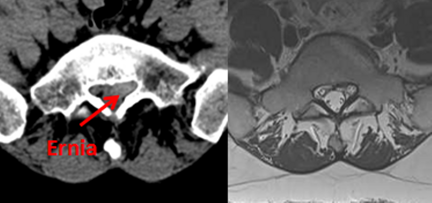 Ozonoterapia ecoguidata Milano e Parabiago comoda con la Svizzera dettaglio ernia Ozonoterapia ecoguidata Milano e Parabiago comoda con la Svizzera dettaglio ernia