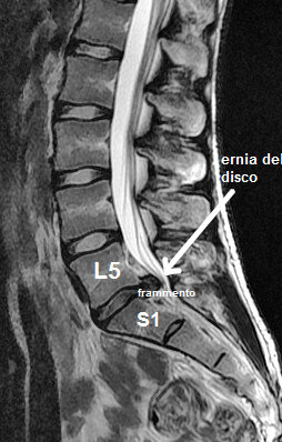 Ozonoterapia ecoguidata Milano e Parabiago comoda con la Svizzera dettaglio frammento ernia del disco L5 Ozonoterapia ecoguidata Milano e Parabiago comoda con la Svizzera dettaglio frammento ernia del disco L5