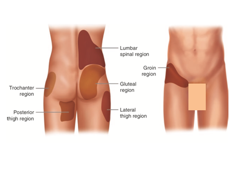 Ozonoterapia ecoguidata Milano Parabiago sindrome faccette lombari zone del dolore Ozonoterapia ecoguidata Milano Parabiago sindrome faccette lombari zone del dolore