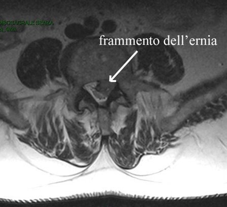Ozonoterapia ecoguidata Milano e Parabiago comoda con la Svizzera dettaglio frammento della ernia 2 Ozonoterapia ecoguidata Milano e Parabiago comoda con la Svizzera dettaglio frammento della ernia 2