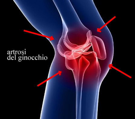 Ozonoterapia ecoguidata Milano Parabiago artrosi del ginocchio vista laterale