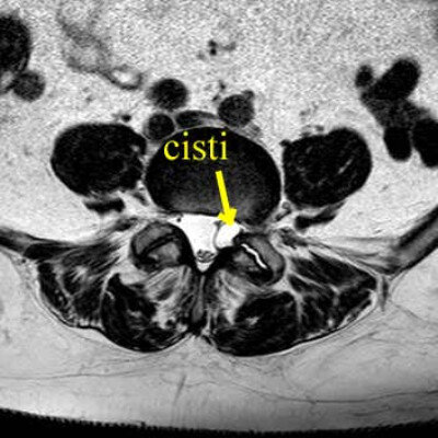 Ozonoterapia ecoguidata Milano e Parabiago comoda con la Svizzera dettaglio cisti lombare 1 Ozonoterapia ecoguidata Milano e Parabiago comoda con la Svizzera dettaglio cisti lombare 1