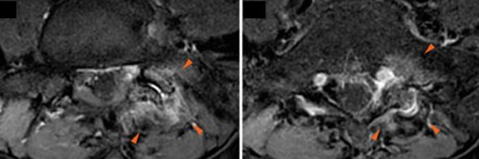 Ozonoterapia ecoguidata Milano Parabiago sindrome faccette lombari articolari evidenza 3 Ozonoterapia ecoguidata Milano Parabiago sindrome faccette lombari articolari evidenza 3