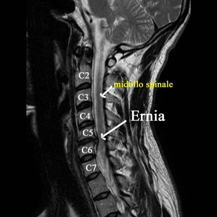 Ozonoterapia ecoguidata Milano e Parabiago comoda con la Svizzera dettaglio ernia midollo spinale Ozonoterapia ecoguidata Milano e Parabiago comoda con la Svizzera dettaglio ernia midollo spinale