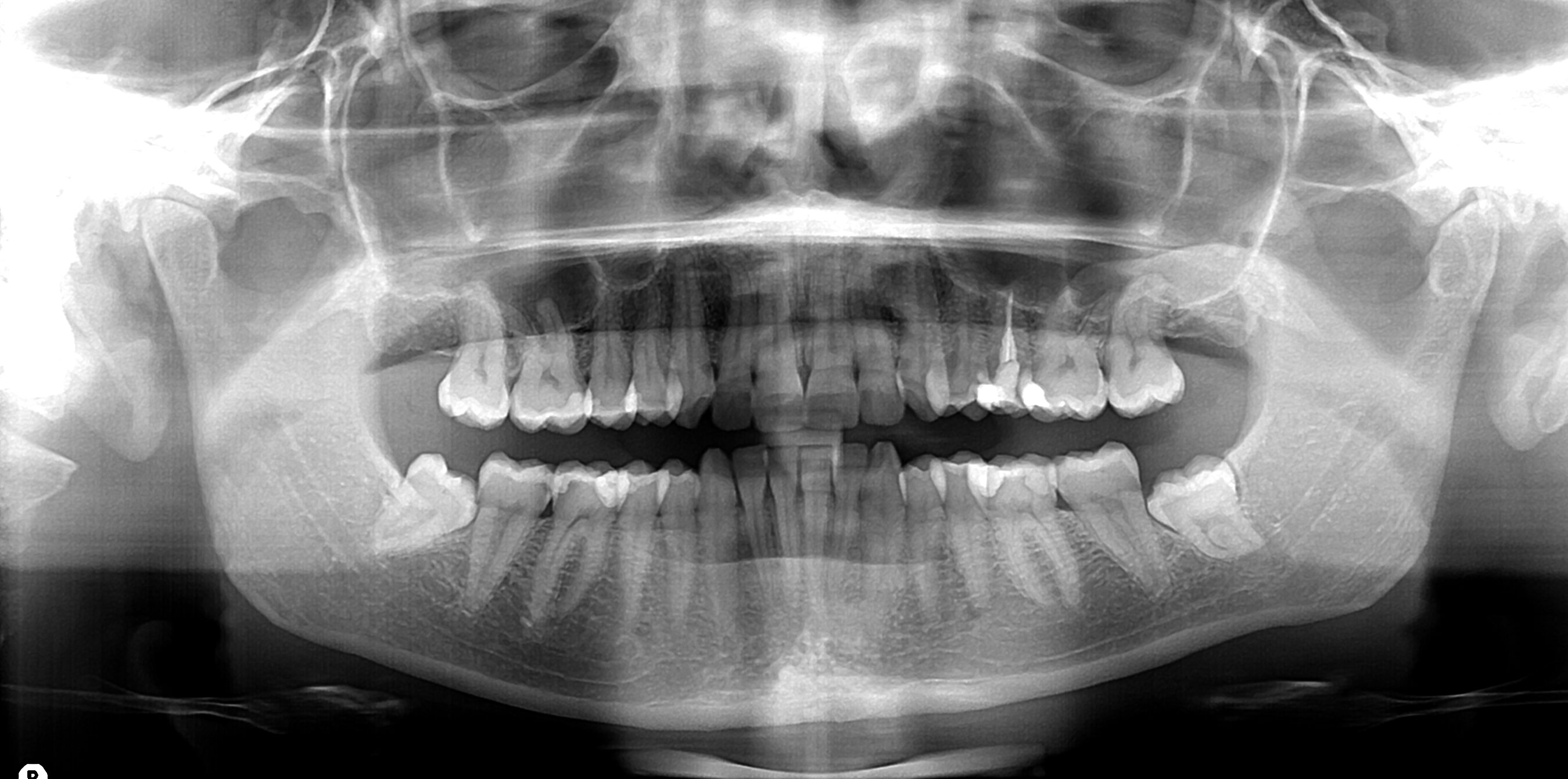 Radiografie dentali, sono rischiose per la salute? Radiografie dentali, sono rischiose per la salute?