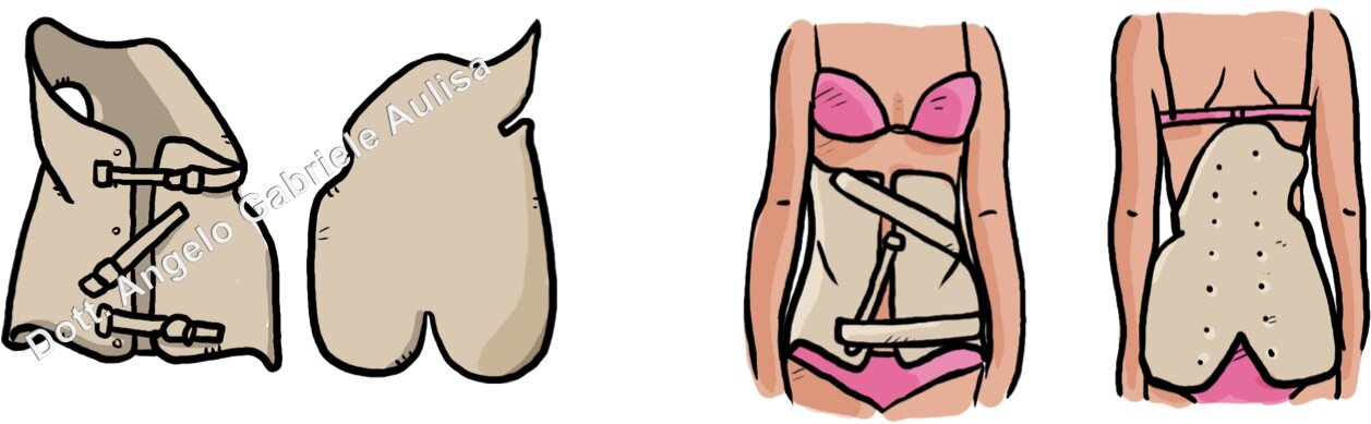 Le domande di una ragazza sulla Scoliosi.