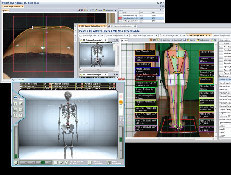 Validazione del Biometrical Holistic Of Human Body (BHOHB) nella diagnosi di scoliosi.