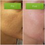 laser co2 frazionato acne