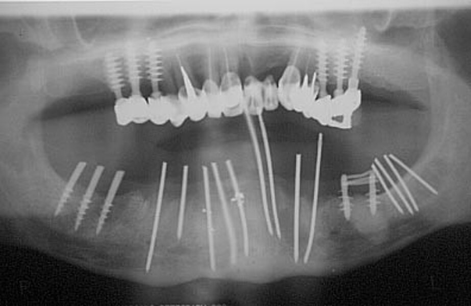 Controllo radiologico intraoperatorio