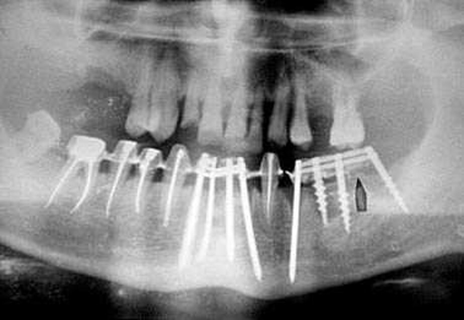 Controllo radiologico alla fine dell?intervento