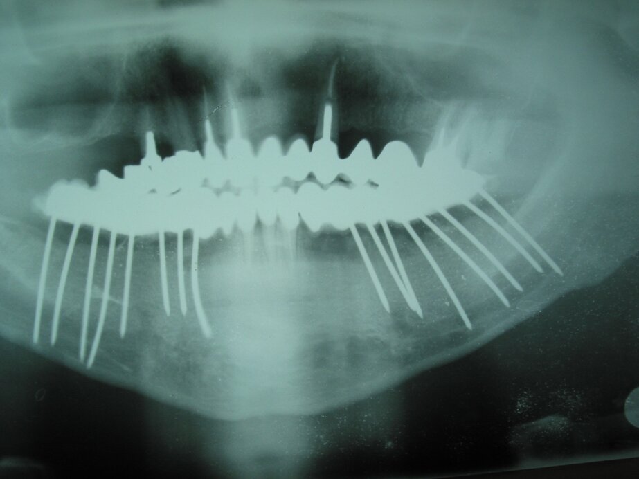 Radiografia dopo 2 mesi