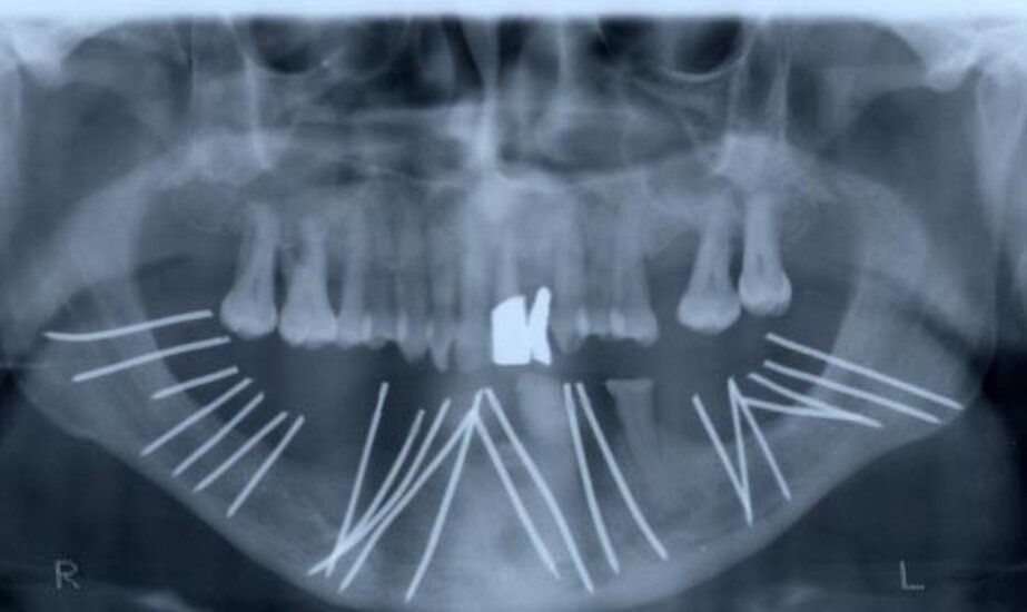 Controllo radiologico a fine intervento chirurgico