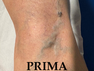 sclero prima.jpeg sclero prima.jpeg