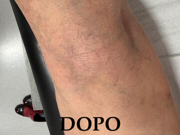 sclero.jpeg sclero.jpeg