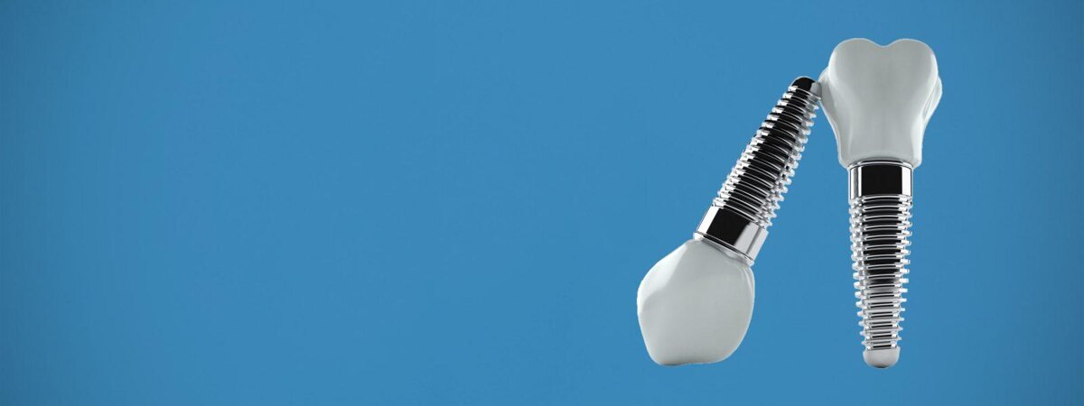 impianti dentali.jpeg impianti dentali.jpeg