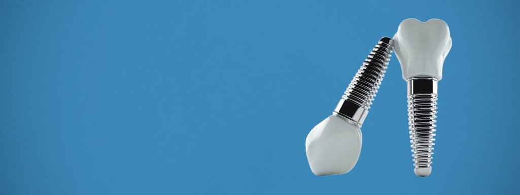 impianti dentali.jpeg impianti dentali.jpeg