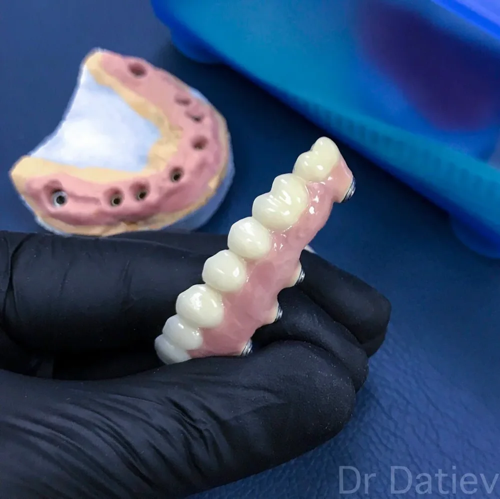 protesi su impianti protesi su impianti