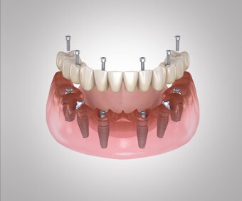 full-arch-dental-implants.jpeg