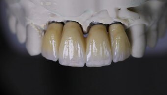 zirconio stratificato ceramica.jpeg zirconio stratificato ceramica.jpeg