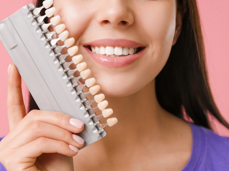 faccette dentali estetiche