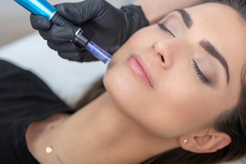 needling viso professionale needling viso professionale