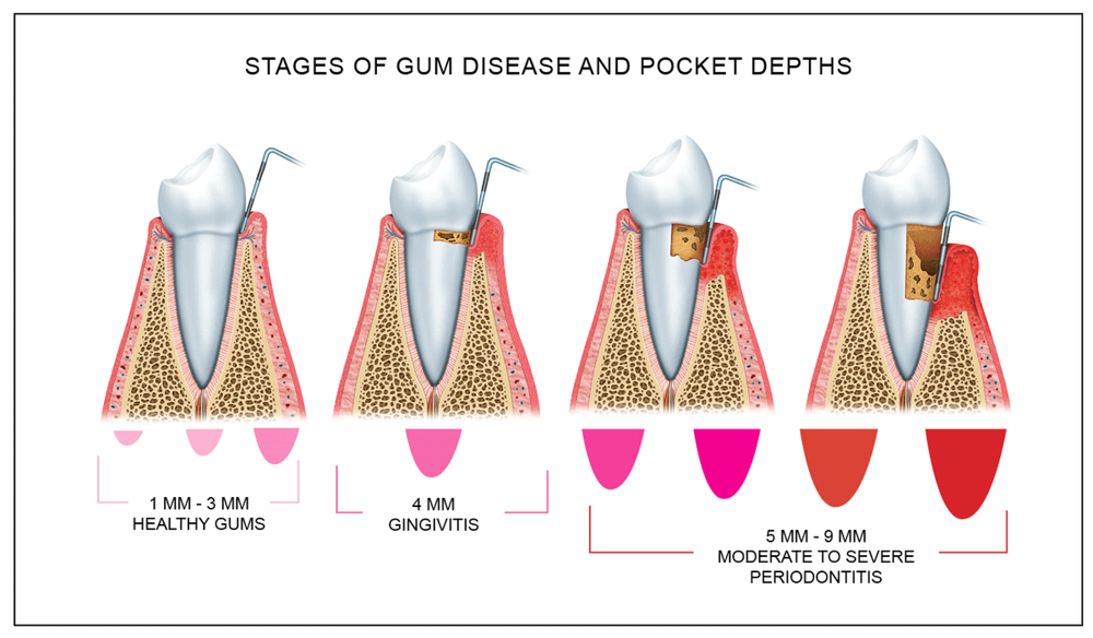 periodontal-probing