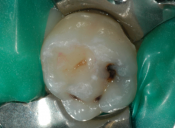otturazione-dente-da-latte-1-situazione-iniziale-300x220 (1)