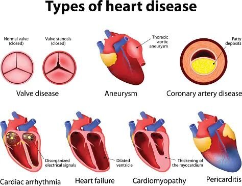 Malattie valvolari cardiache: cosa sono e come vengono trattate