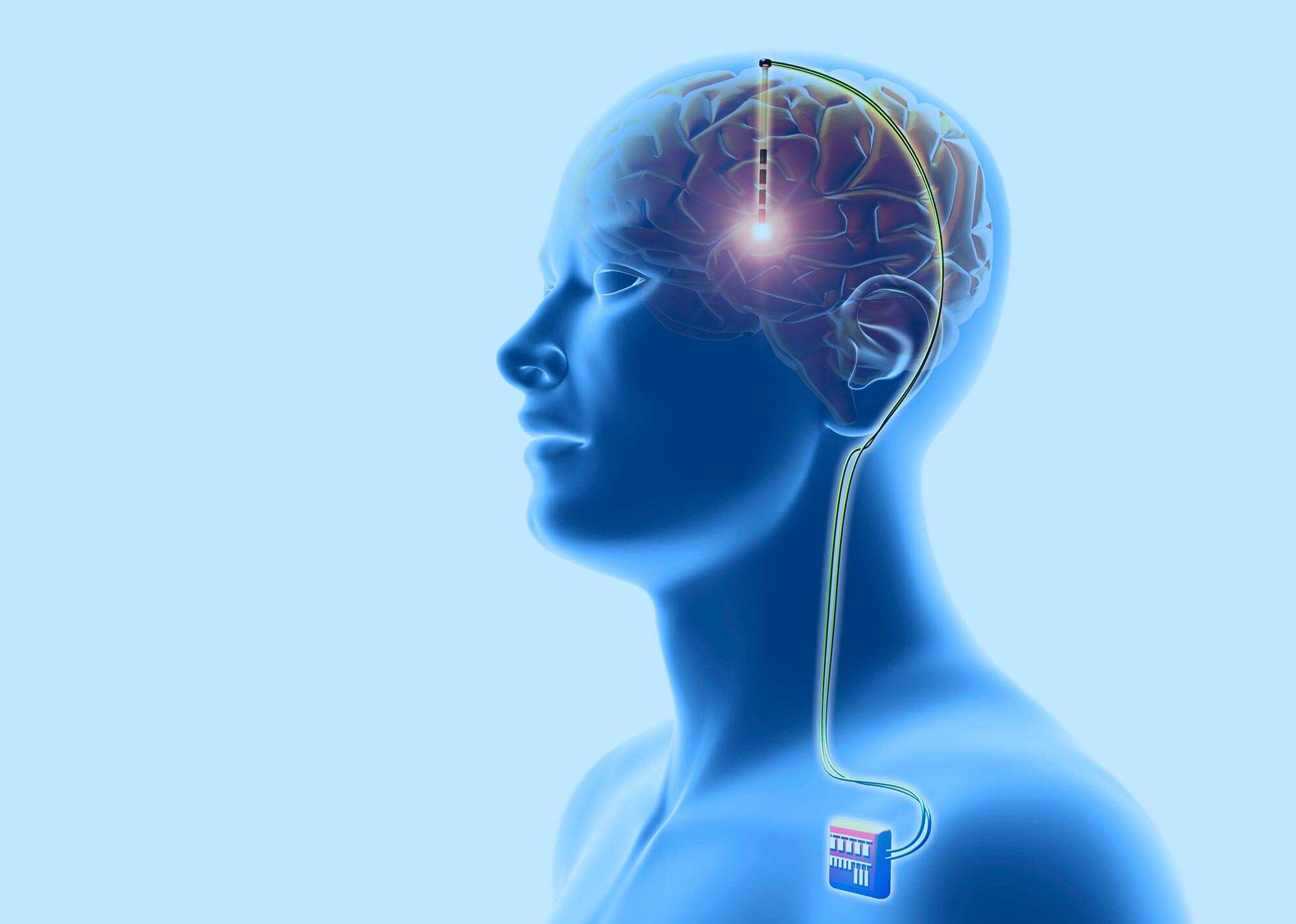 Morbo di Parkinson: approccio integrato e Deep Brain Stimulation