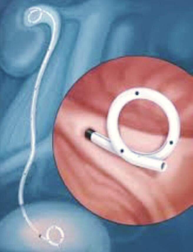 Stent o non stent