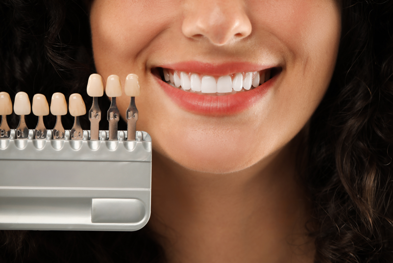 faccette dentali in ceramica