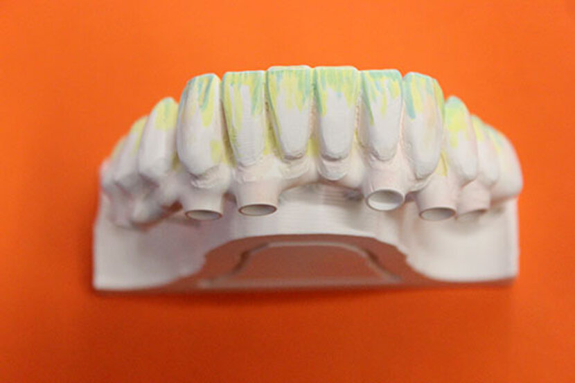 Arcata completa in zirconio con colorazione di superficie