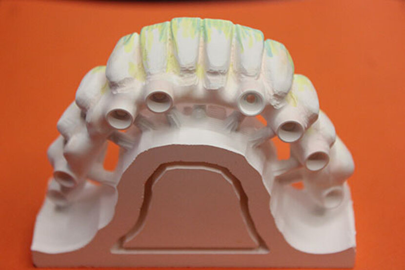 Arcata completa in zirconio