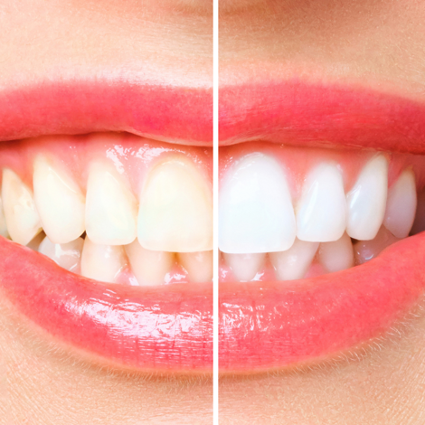 sbiancamento dentale professionale