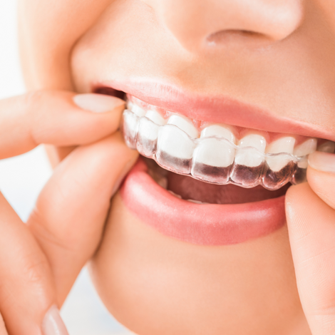 faccette dentali 