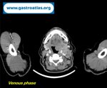tonsil-lymphoma