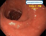 celiac-disease-two-unexpected-cases