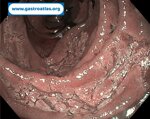 duodenal-adenoma