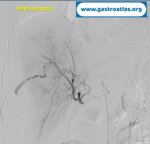 percutaneous-liver-biopsy-hematoma