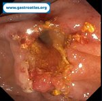 choledocholithiasis-ercp